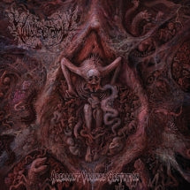VULVECTOMY - ABERRANT VAGINAL GESTATION [CD]